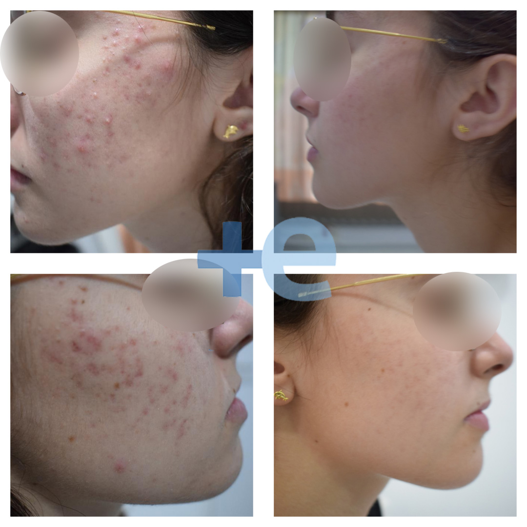 terapia acné antes y después euroclinicas de especialidades vera almeria